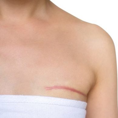 3 μύθοι για την αποκατάσταση μαστού μετά από μαστεκτομή