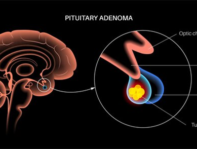 Αδένωμα υπόφυσης. Τι γνωρίζετε για την ύπαρξή του;