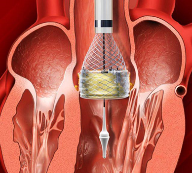 Στένωση αορτικής βαλβίδας και θεραπεία με διαδερμική εμφύτευση Tavi – όλα όσα πρέπει να γνωρίζετε